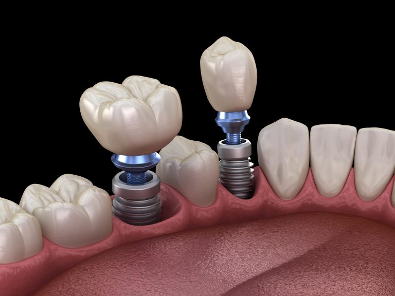 Premolar And Molar Tooth Crown Installation Over Implant Concept. 3d Illustration Of Human Teeth And Dentures